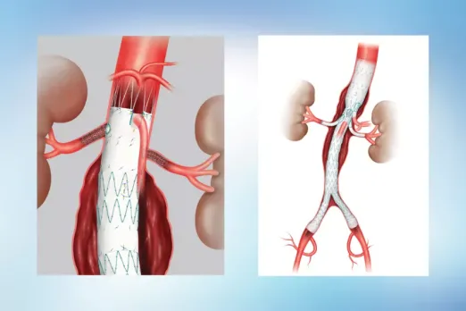 Illustrations showing how stent graft devices are placed to repair abdominal aortic aneurysms